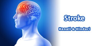 Jangan Anggap Enteng Gejala Stroke